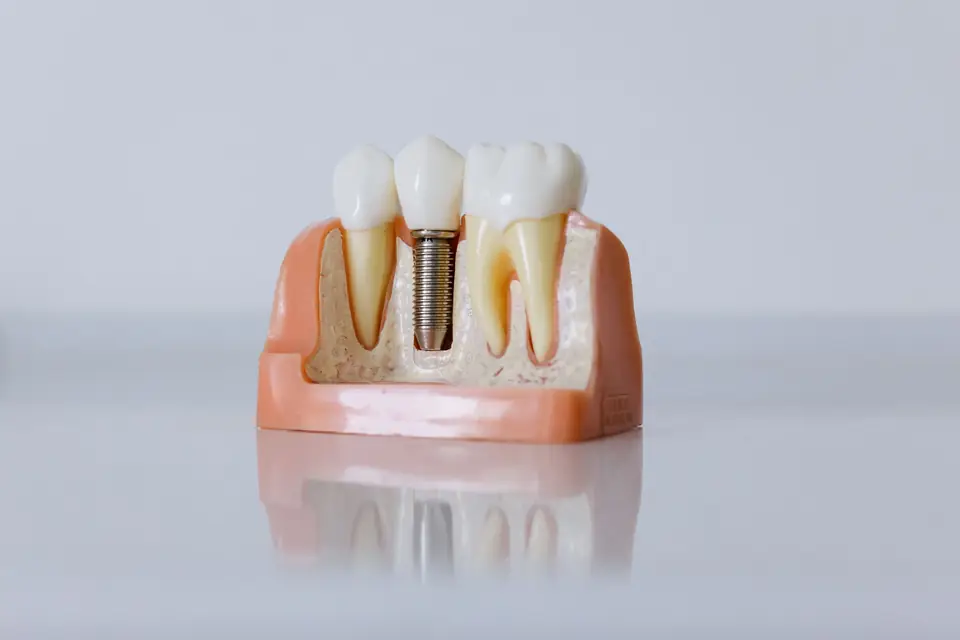 Modelo de un implante dental con su corona